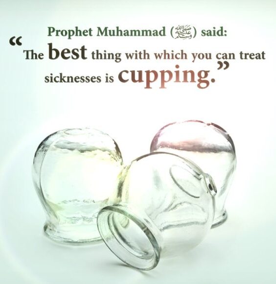 Hijama, cupping therapy